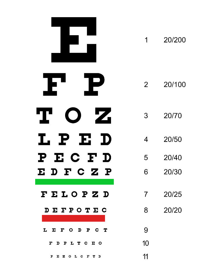 A person is deemed legally blind when there vision is 20/200. This means that what a person with normal vision can see at 200' ft., a legally blind person has to be 20' ft away to see the same.